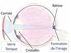 Astigmatisme - œil Astigmate avec correction