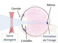 Myope - Myopie correction